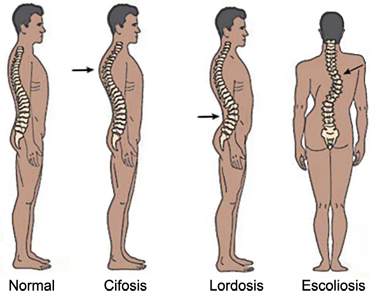 Espalda Columna Vertebral Escoliosis Lordosis Cifosis Deformacion Mesodermo Nuevo