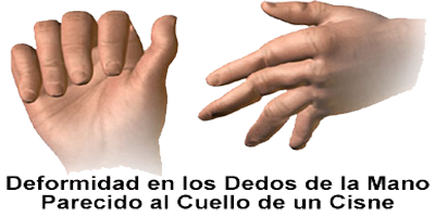 Deformidad Dedos Mano Artrosis Cuelo Cisne