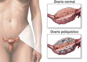 Ovario Normal Poliquistico Mesodermo Nuevo