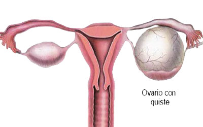 Ovarios Quiste Mesodermo Nuevo