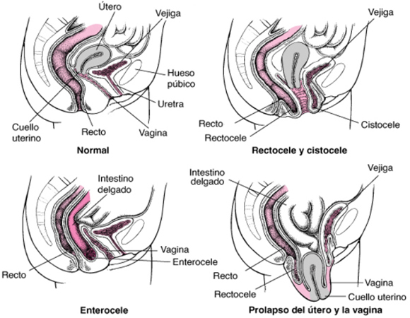 Suelo Pelvico Femenino Prolapso Utero Vagina Recto Organos Mesodermo Nuevo