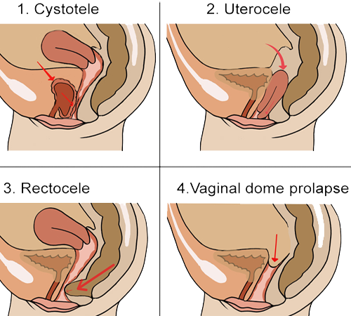 Suelo Pelvico Femenino Prolapsos Cystocele Uterocele Rectocele Vagina Mesodermo Nuevo