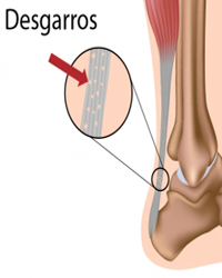 Tendones Ligamentos Huesos Desgarros Mesodermo Nuevo