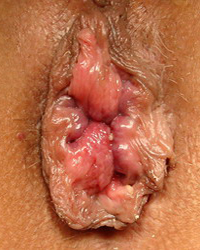 Venas Varicosas Varices Anales Hemorroides Mesodermo Nuevo