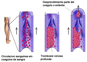 Venas Flujo Sanguinero Trombosis Embolia Desprendimiento Mesodermo Nuevo
