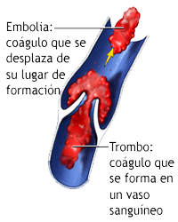 Venas Flujo Sanguinero Coagulo Trombosis Embolia Mesodermo Nuevo