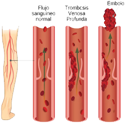 Venas Flujo Sanguinero Trombosis Embolia Mesodermo Nuevo
