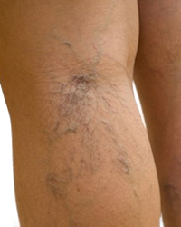 Venas Varicosas Varices Piernas Mesodermo Nuevo