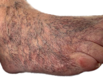 Venas Varicosas Varices Pie Mesodermo Nuevo