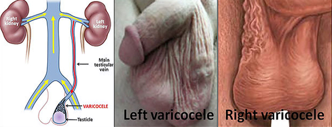 Testiculos Varicocele Izquierdo Derecho Venas Varicosas