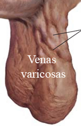Venas Varicosas Varices Testiculos Escroto Varicocele Mesodermo Nuevo