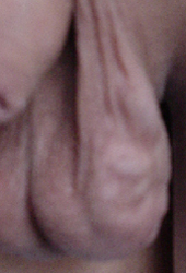 Venas Varicosas Varices Testiculos Escroto Varicocele Foto Mesodermo Nuevo