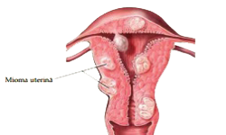 Utero Miometrio Miomas Uterinos