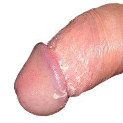 Esmegma Pene Glande Prepucio