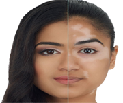 Mujer Vitiligo Cara Despigmentacion Mancha Blanca