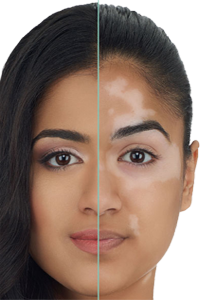 Vitiligo Cara Piel Despigmentacion Melanocitos Melanina Ectodermo