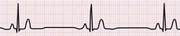 Ritmo Cardiaco Lento Bradicardia Bradiarritmia