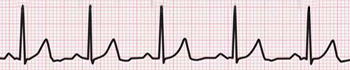 Ritmo Cardiaco Normal 60-100 LPM