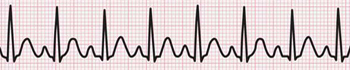 Ritmo Cardiaco Rapido Taquicardia Taquiarritmia
