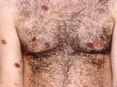 Sarcoma Kaposi SIDA VIH