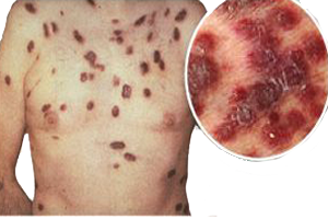 Sarcoma Kaposi Piel Lesiones Melanoma Pecho