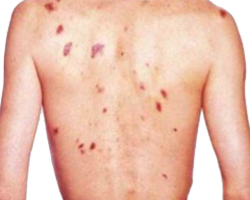 Sarcoma Kaposi Piel Lesiones Melanoma Espalda