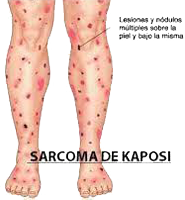 Sarcoma Kaposi Piel Lesiones Melanoma Piernas