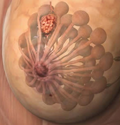 Seno Mama Glandulas Mamarias Tumor Conductos Galactoforos 