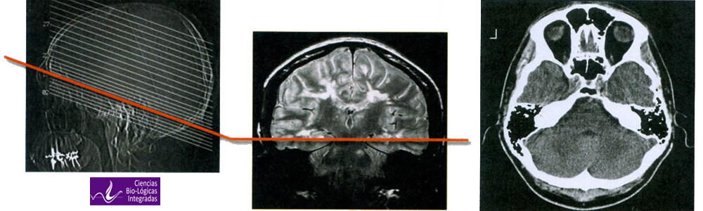 TAC Tomografia Axial Computarizada Cerebelo Mesodermo Antiguo