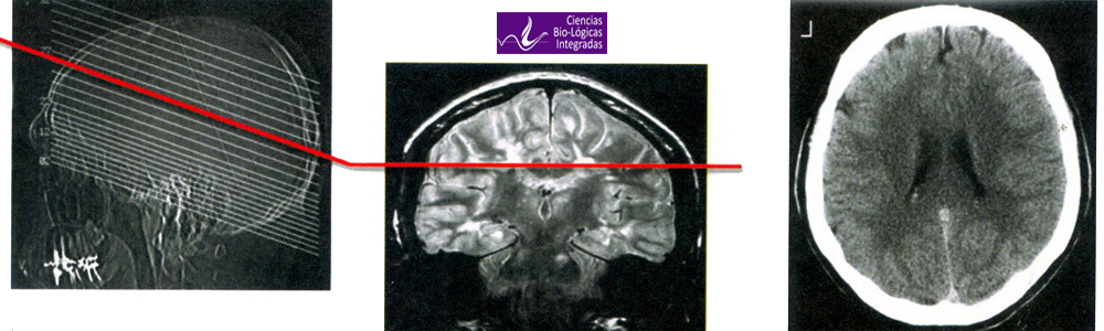 TAC Tomografia Axial Computarizada Corteza Cerebral Ectodermo