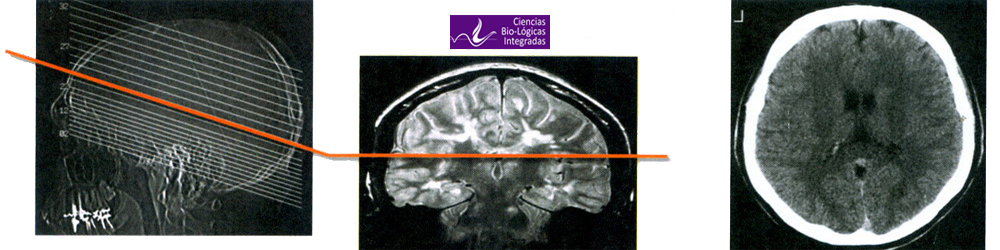 TAC Tomografia Axial Computarizada Sustancia Blanca Medula Cerebral Mesodermo Nuevo