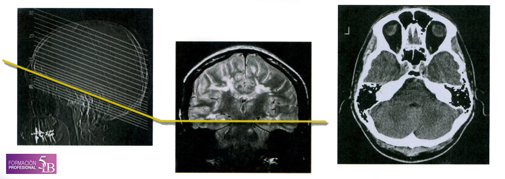 TAC Tomografia Axial Computarizada Tronco Tallo Cerebral Endodermo