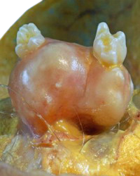 Teratoma Estructuras Organica Dientes