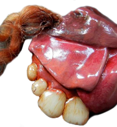 Teratoma Estructuras Organica Dientes Pelo