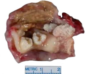 Teratoma Estructuras Organica Dientes Tejidos