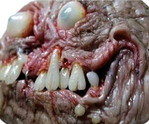 Teratoma Estructuras Organica Dientes Ojos