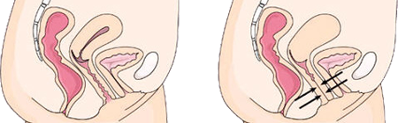 Vaginismo Vagina Estrecha Cerrada