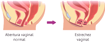 Vaginismo Estrechez Apertura Vaginal