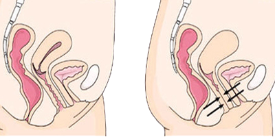 Vaginismo Vagina Estrecha Cerrada